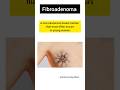 fibroadenoma (breast में गाठ) #shorts #shortvideo #ayurveda