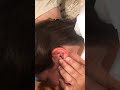 EARWIG CRAWLS OUT OF MY WIFES EAR!