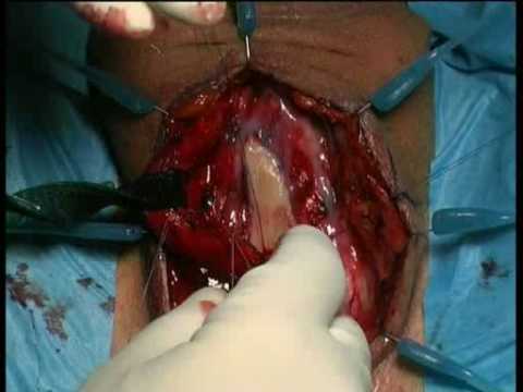 Bulbar Urethroplasty - Muscle And Nerve Sparing