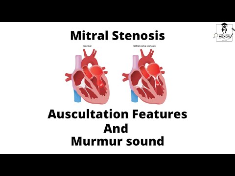Mitral Stenosis Auscultation features & Murmur sound description