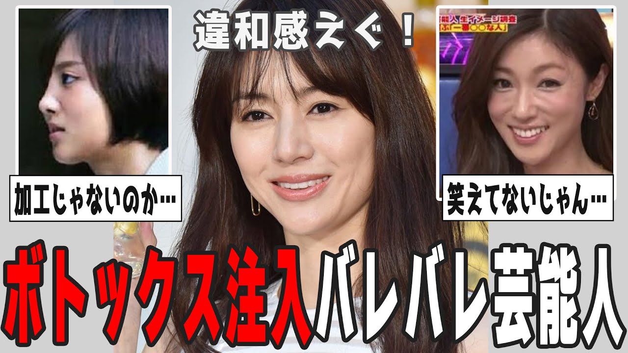 【2ch有益】なんでやっちゃった？ヒアルロン酸・ボトックス注入バレバレ芸能人【ガルちゃん】