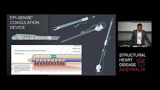 Hybrid Catheter & Minimally Invasive Ablation for Persistant Atrial Fibrillation – Dr Pragnesh Joshi