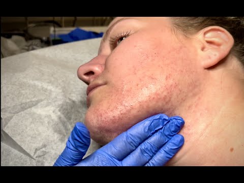 72 HOURS of Electrolysis Permanent Facial Hair Removal...
