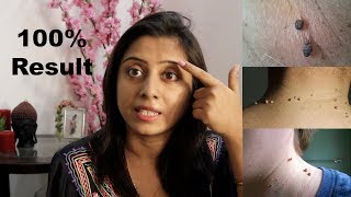 Remove Skin Tags in 1 Night || 3 Amazing Way to Remove Skin Tags || Preventing Naturally Soumali