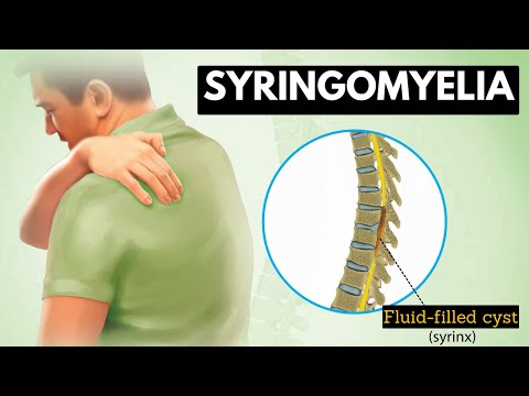 Syringomyelia: Everything You Need To Know