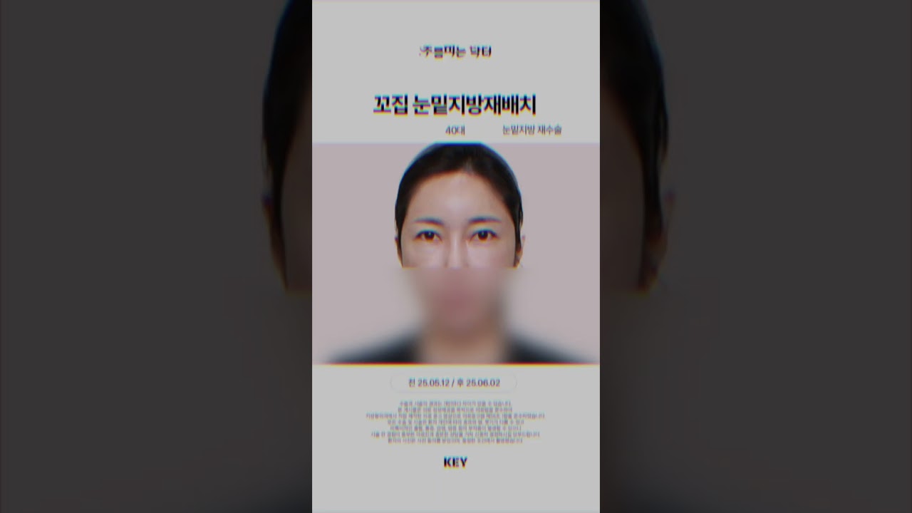 40대 눈밑재수술 꼬집눈밑지방재배치 대구키성형외과