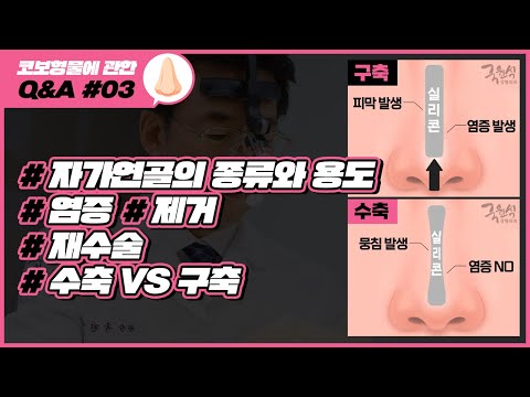 실리콘 보형물에 관한 Q&A #03｜#자가연골 #코보형물염증 #코보형물제거 #코재수술 #수축 등｜코성형 부작용