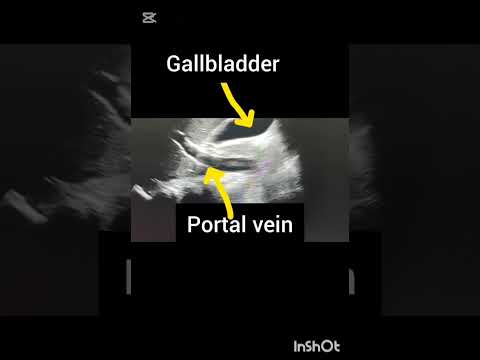 Ultrasound showing Gallbladder!Portal vein! Ultrasound Abdomen! #ultrasoundmadeeasy86# #radiology