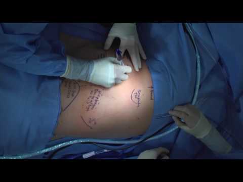 Technique for Chest Tube Insertion