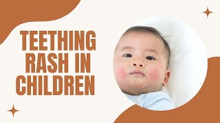 Teething Rash in Children (3 Prevention tips)