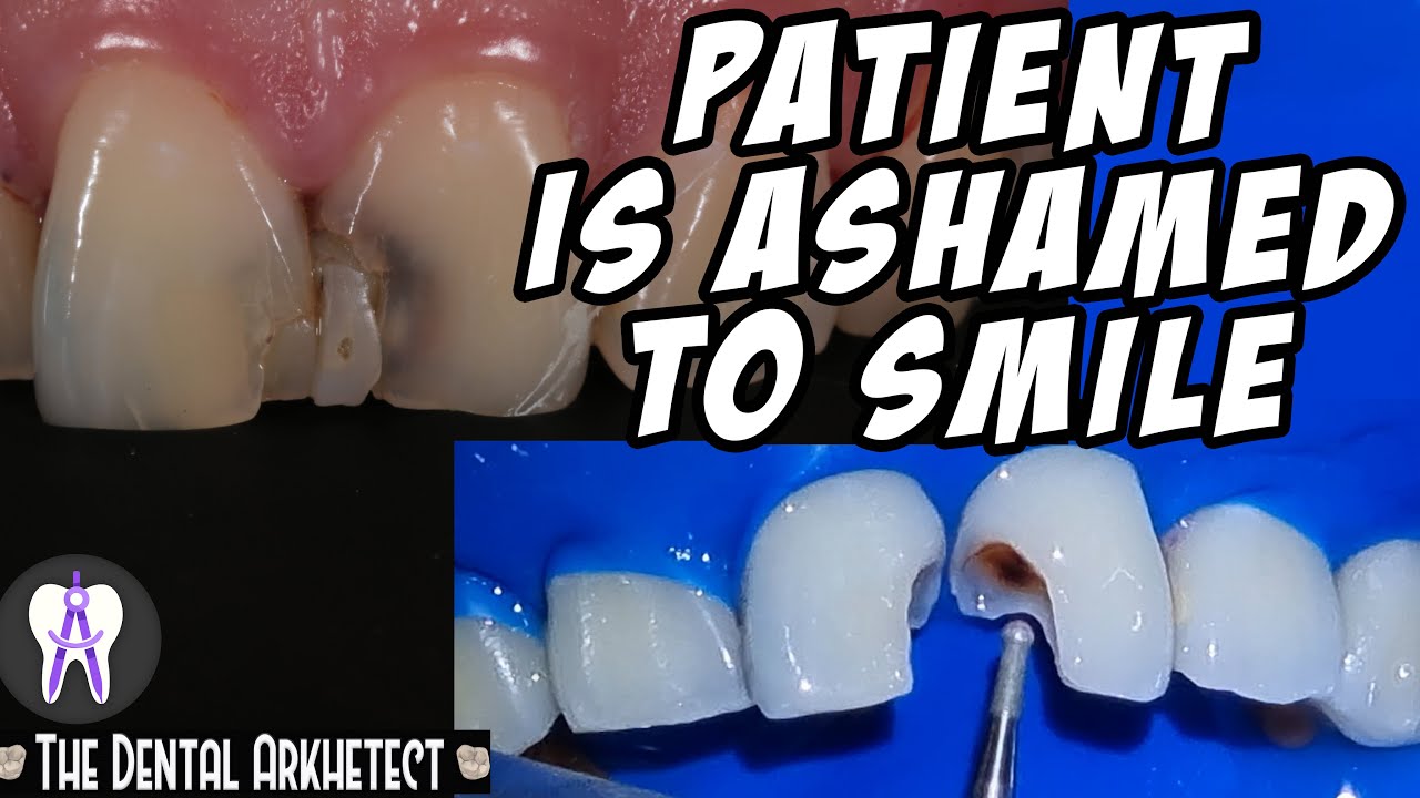 Making the Patient Smile Confidently Again.. Big Caries/cavity in his front teeth..