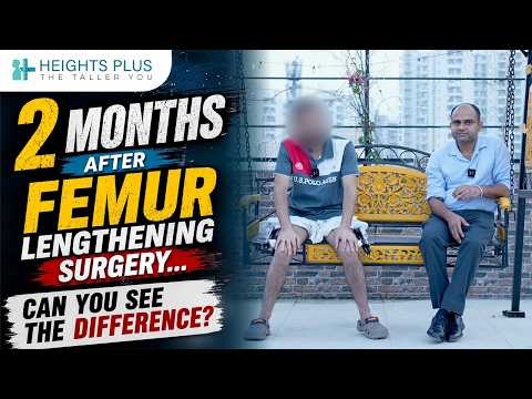 2 Months After Femur Lengthening Surgery | Can You See the Difference? Recovery Update