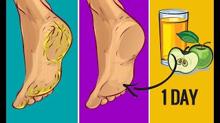 Get Rid Of Cracked Heels In Just 1 day Naturally