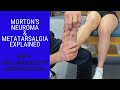 Morton S Neuroma And Metatarsalgia What S The Difference