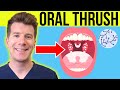 Doctor explains ORAL THRUSH (Oral Candidiasis) | Symptoms, treatment, & prevention in adults/babies