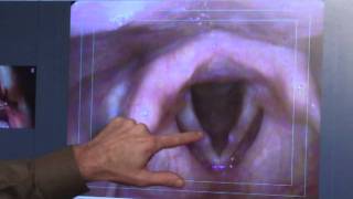 Hemorrhagic vocal cord polyps Part I (SD)
