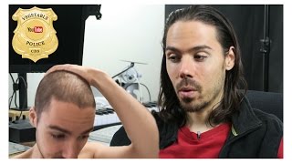 How to Stop and Reverse Male Pattern Baldness. Diet, Herbs and Shampoo Tips