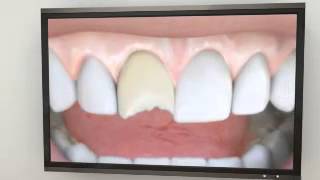 preview picture of video 'Porcelain Veneers In Quincy MA - 617-328-1726'