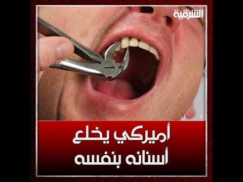 شاهد بالفيديو.. رجل أميركي يقلع أسنانه بنفسه بعد أن فشل بالحصول على علاج مجاني طيلة 15 عاماً | الشرقية