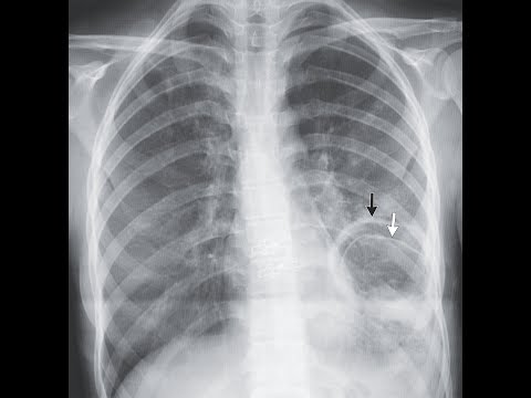 Rupturierte pulmonale  Hydatidenzyste