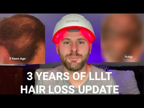 3 Years Of Using Low Level Laser Therapy (LLLT) For Hair Loss - My Results.