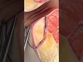 Laser Closure Of Fistula Tract FiLaC Video Credit SurgMedia Youtube Com