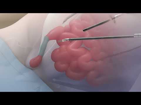 Inguinal Hernia Repair with Da Vinci | Dallas Mind & Body