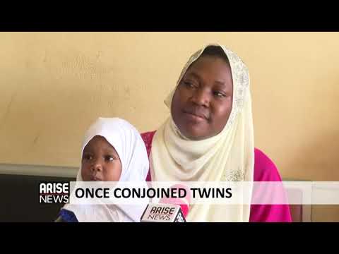 ONCE CONJOINED TWINS -ARISE NEWS REPORT