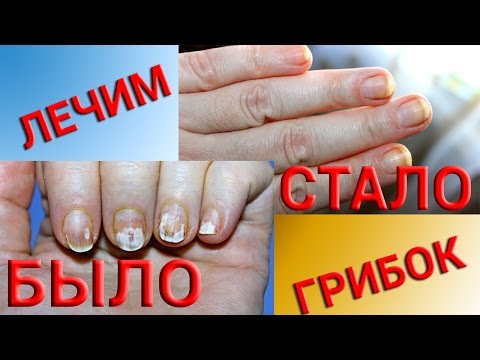 Von gribka otsloilsja der Nagel Die Laserbehandlung des Nagels in samare