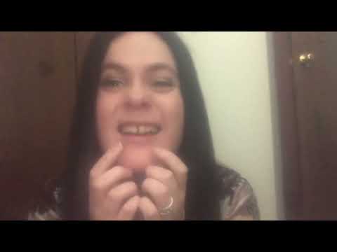 SARPE Surgery/Palate Expander Journey 3-Weeks Post OP