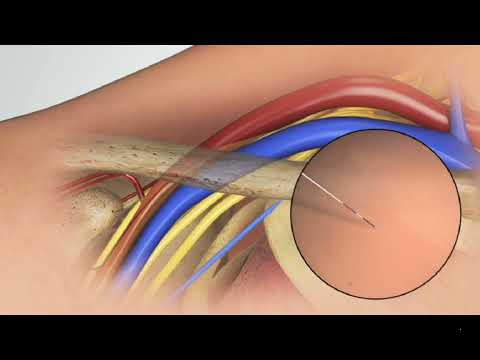 Subclavian Vein Technique