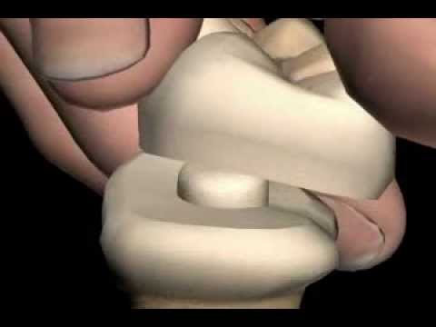 What should you pay attention to when choosing dental crowns?