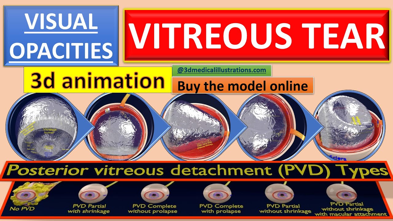 Posterior vitreous detachment types eye 3D Model