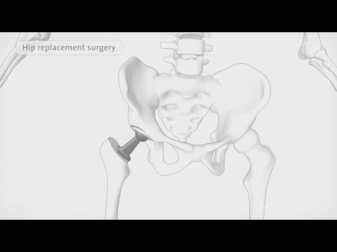 How a hip replacement is performed | Spire Healthcare