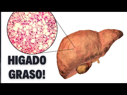 Solución al hígado graso