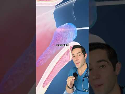 How doctors remove hemorrhoids