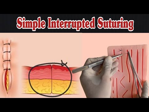 IV Cannula Colour And Size Cannula Types And Uses