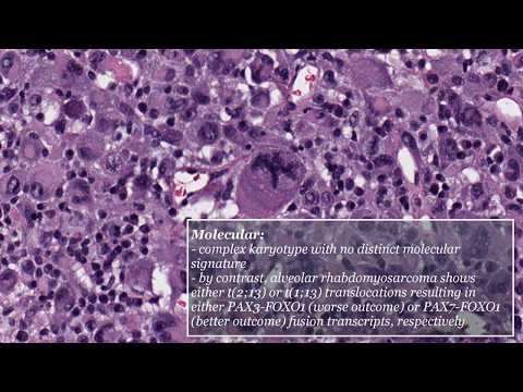 Pleomorphic Rhabdomyosarcoma
