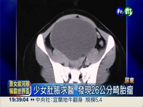 少女長畸胎瘤 恐是未發育雙胞
