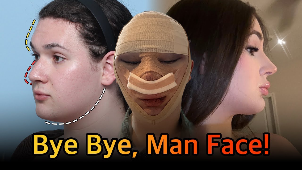 NANA Plastic Surgery FFS transformation from masculine to feminine looks YouTube video