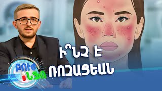 Բուժ ինֆո/Buj Info/Խորհուրդ մասնագետից/Ի՞նչ է ռոզացեան, ո՞ր դեպքերում է այն առաջանում
