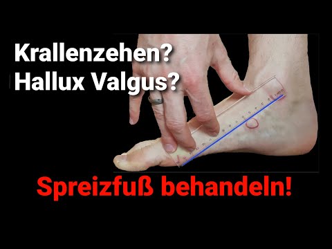 Krallenzehen & Hallux Valgus vom Senk-/Spreizfuß - Übungen & Tests - Gesunde Füße (Teil 2)