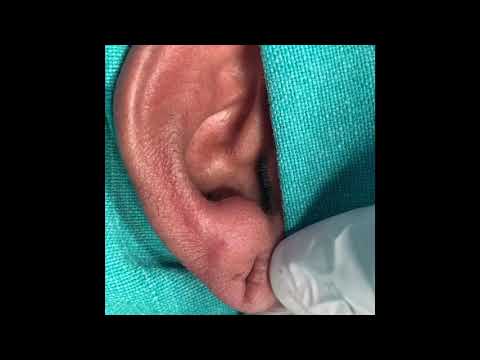 Repairing Of Torn Ear Lobe