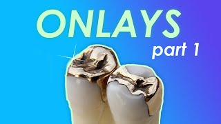 Onlay Case Selection | Ace Courses Webinar Summary