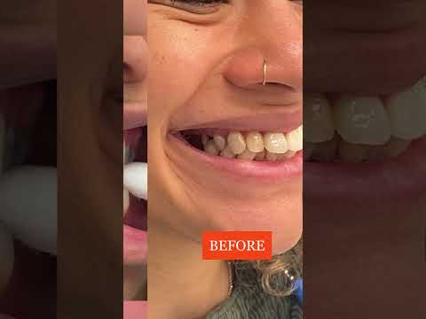 Crazy Before and After! Dental Implants! #dentalimplant #implants #dentistry