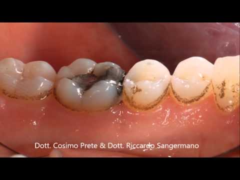 Eliminazione di rimedi di gente di parassiti da un corpo umano Come portare parassiti per mezzo di un garofano