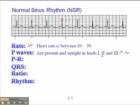 ECG: Normal Sinus Rhythm (NSR)