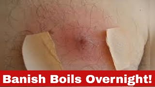 Quick Relief: How to Get Rid of a Boil Overnight!