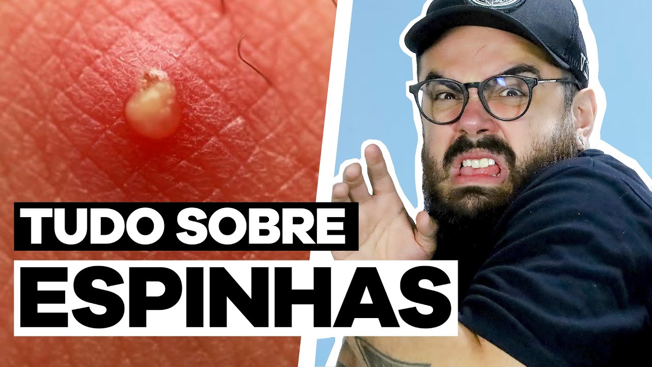 COMO SE LIVRAR DAS ESPINHAS: 8 coisas que você precisa saber!