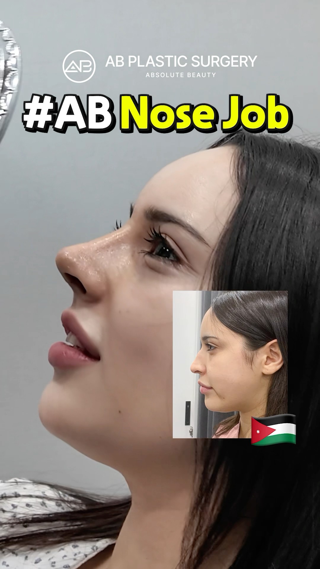 Nose Job Transformation Hump Nose Before & After